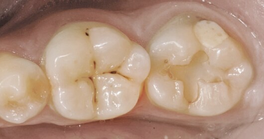 Esthetic replacement of two restorations on mandibular second molar
